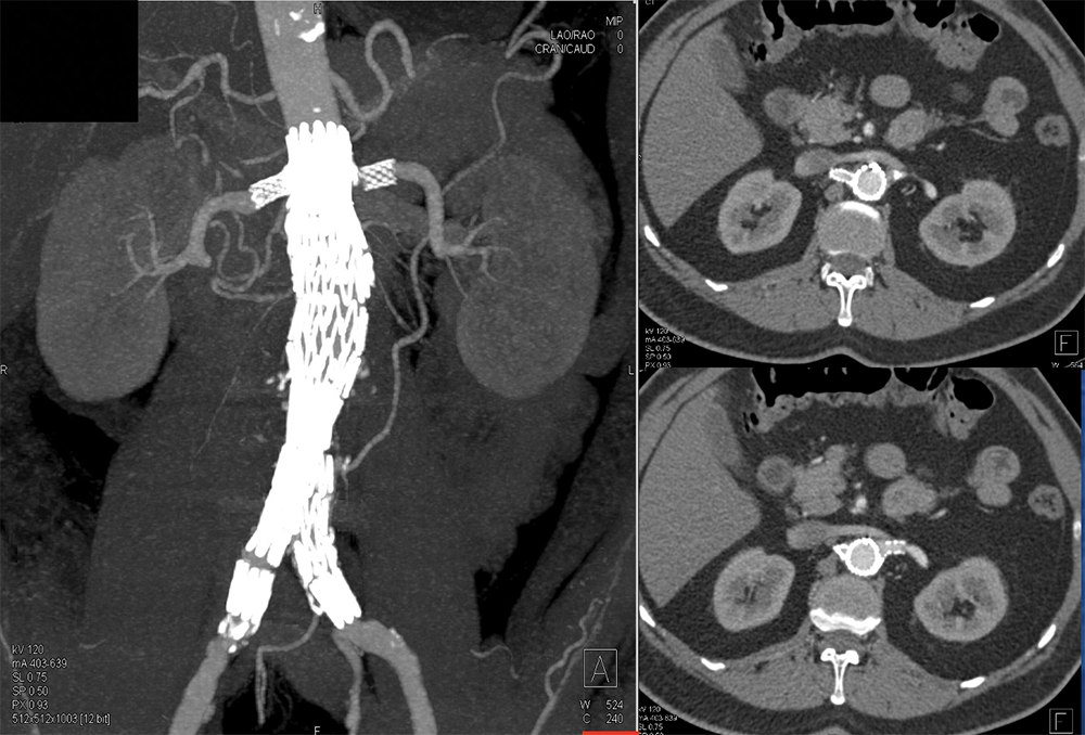 Renal Artery Stenosis