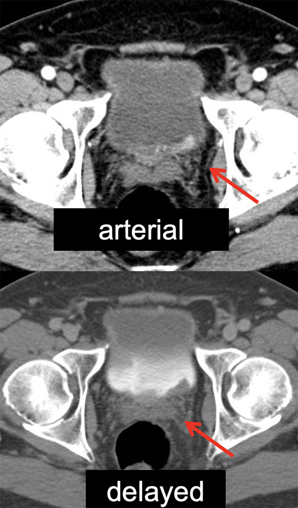 Technique: Hematuria