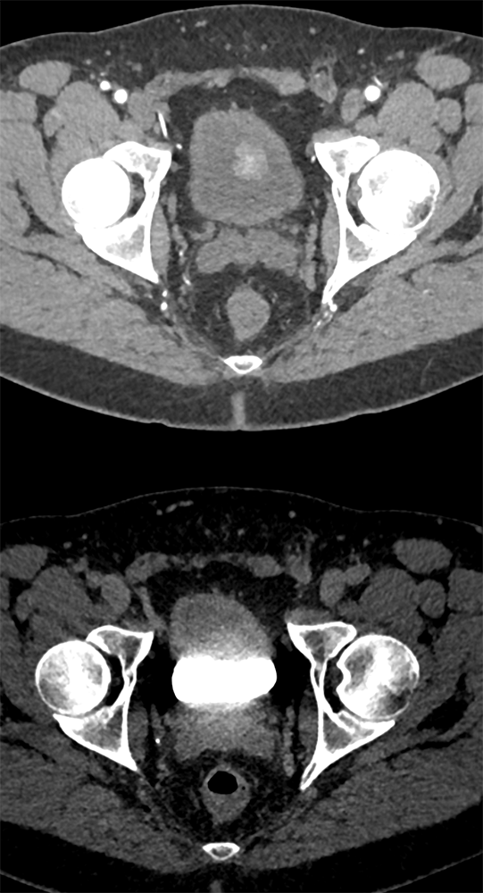 CT of the Bladder