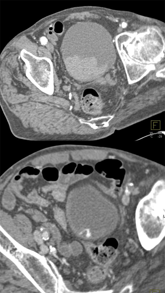 Active Bleed in Bladder: Dx