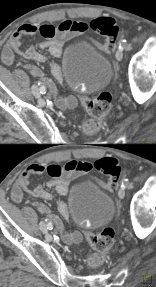 CT of the Bladder