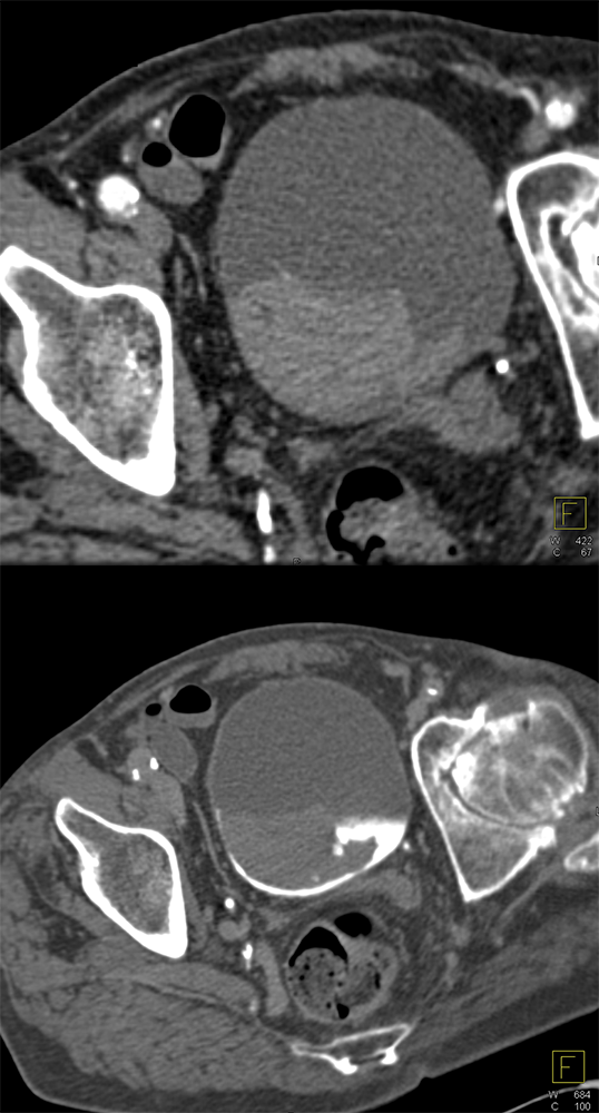 CT of the Bladder