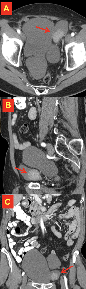 Transitional Cell Carcinoma