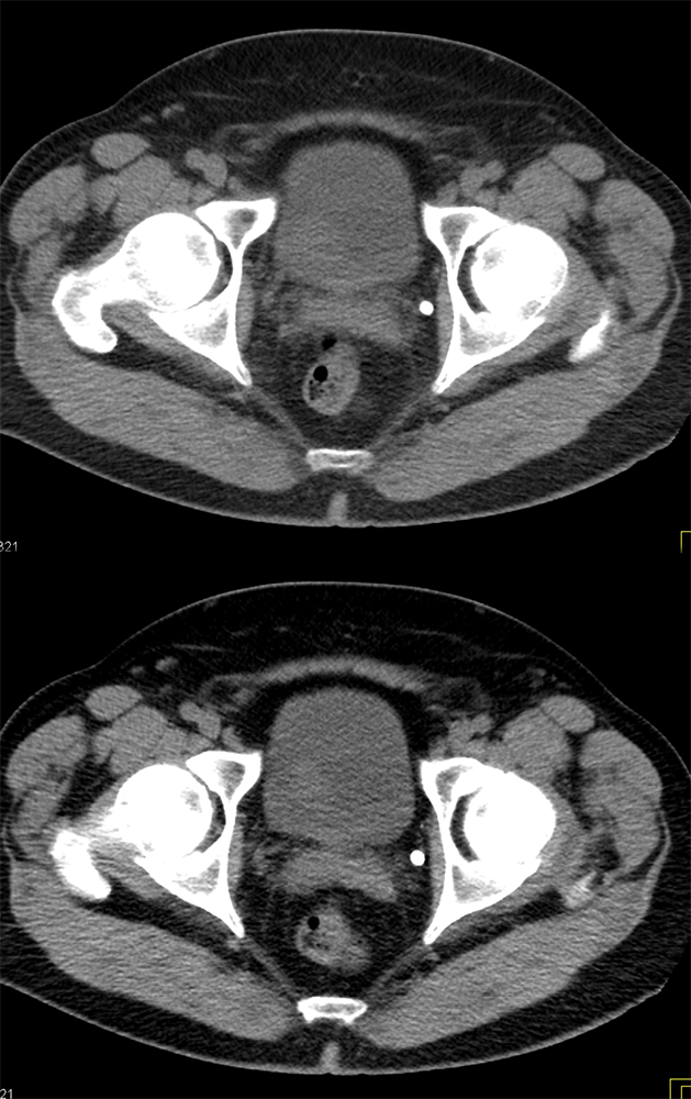 Paraganglioma Bladder