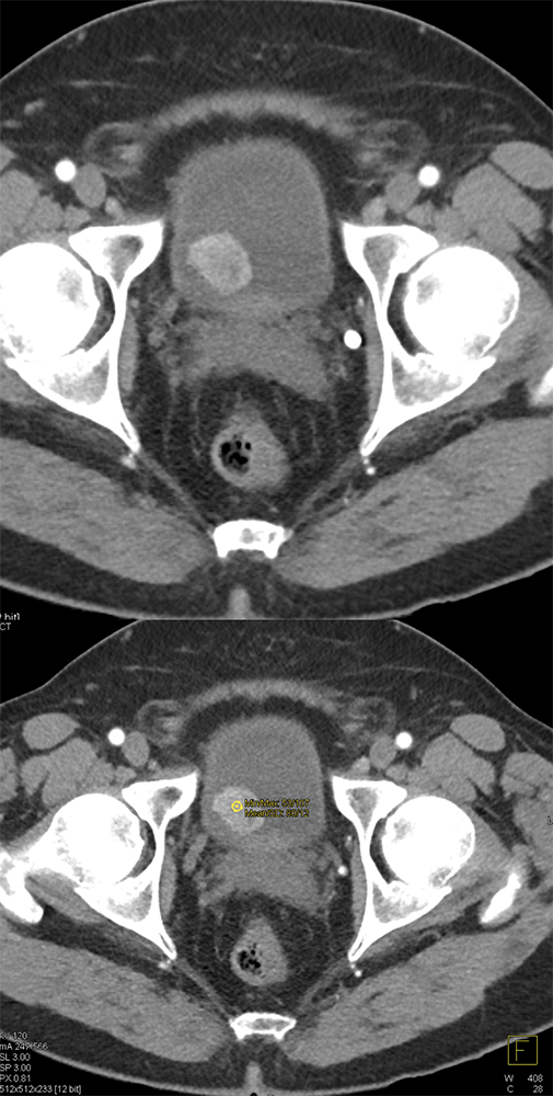 CT of the Bladder