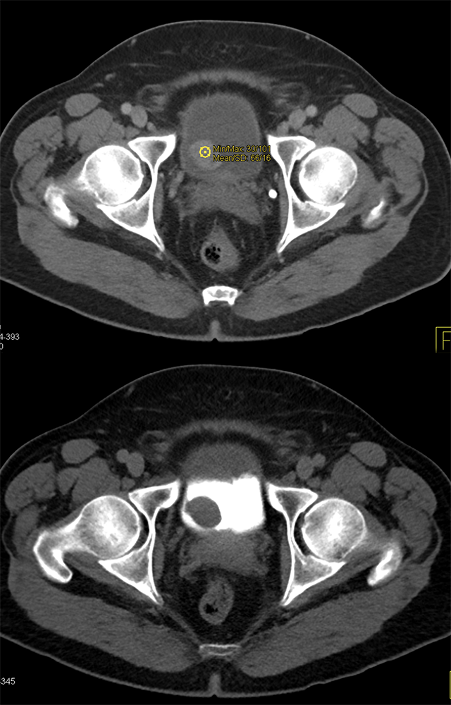 CT of the Bladder