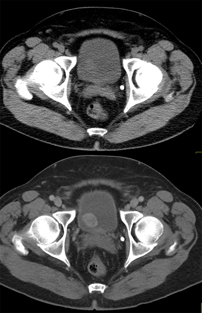 CT of the Bladder