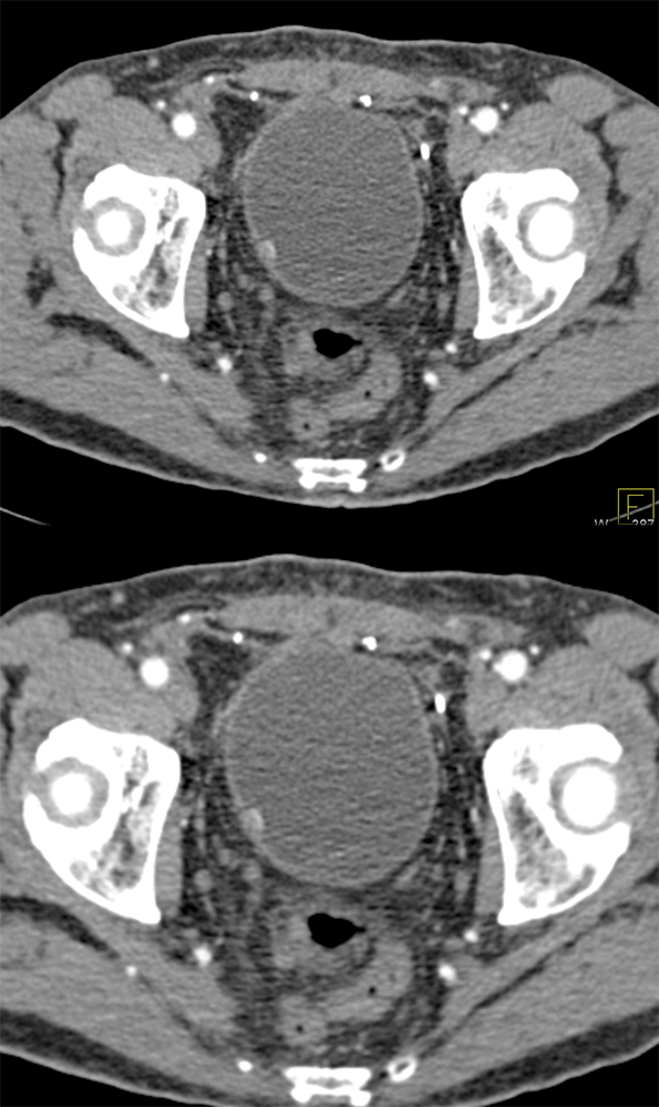 Subtle Bladder Cancer