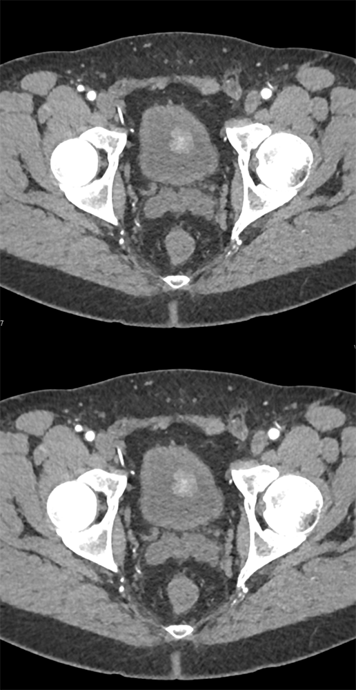 Bladder Cancer best seen Early Phase