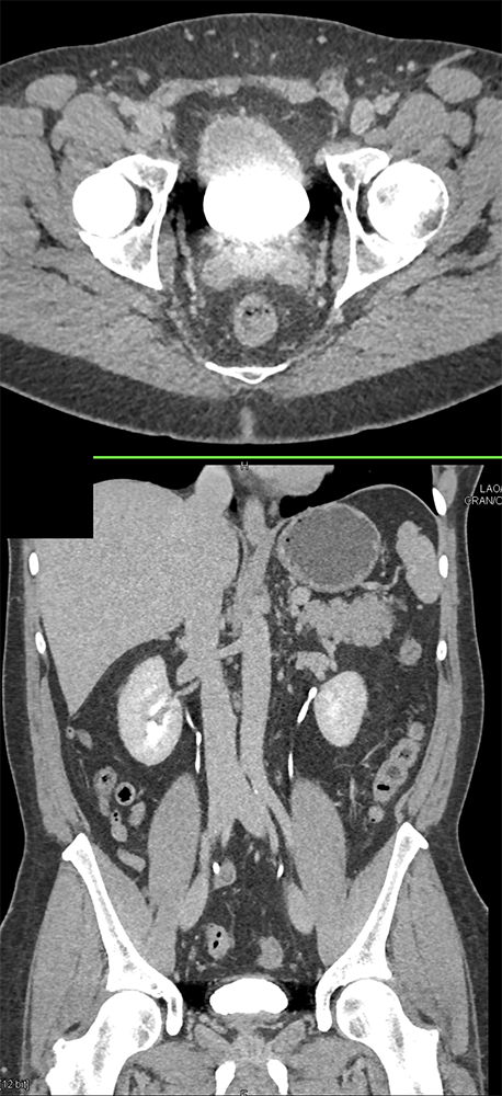 CT of the Bladder