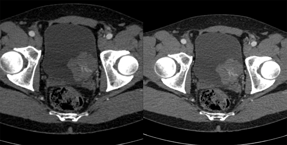 Bladder Cancer