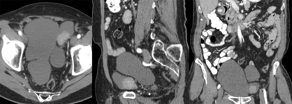 Bladder Cancer in a Diverticulum