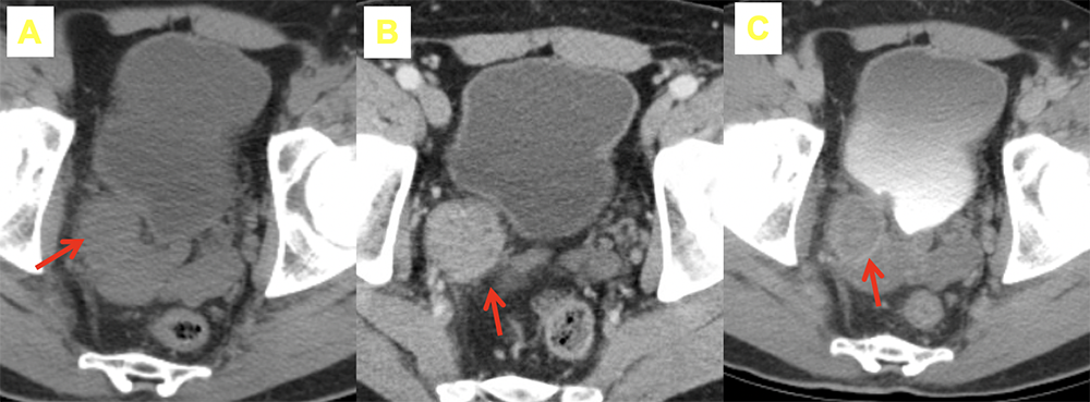 TCC in Bladder Diverticulum