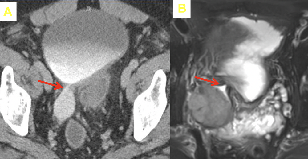 TCC in Bladder Diverticulum