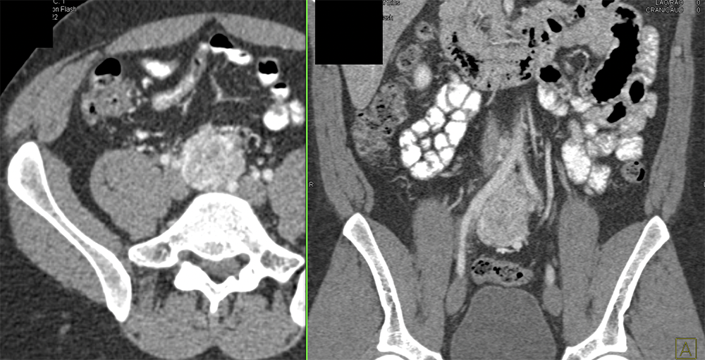 Pheochromocytoma in Organ of Zuckerkandl