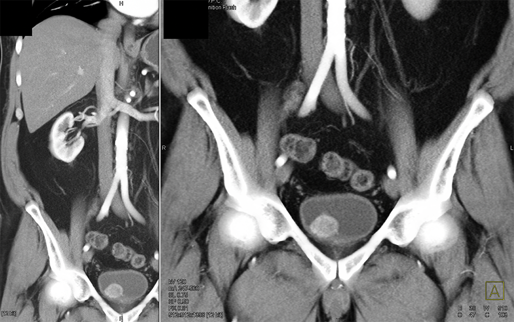 Bladder Pheochromocytoma