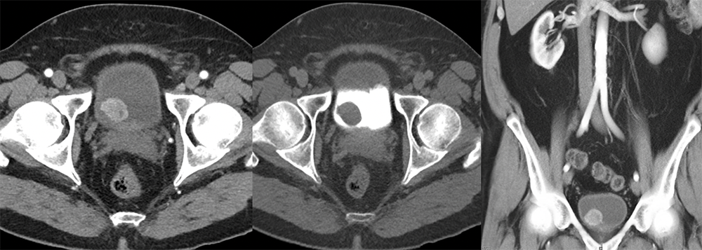 Bladder Paraganglioma