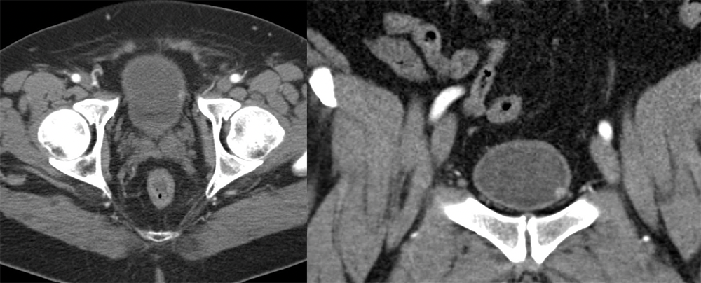 Bladder Paraganglioma