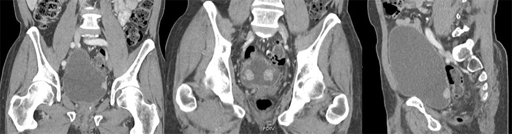 Metastatic Prostate Cancer to the Bladder