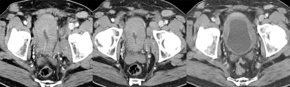 Bladder Lymphoma