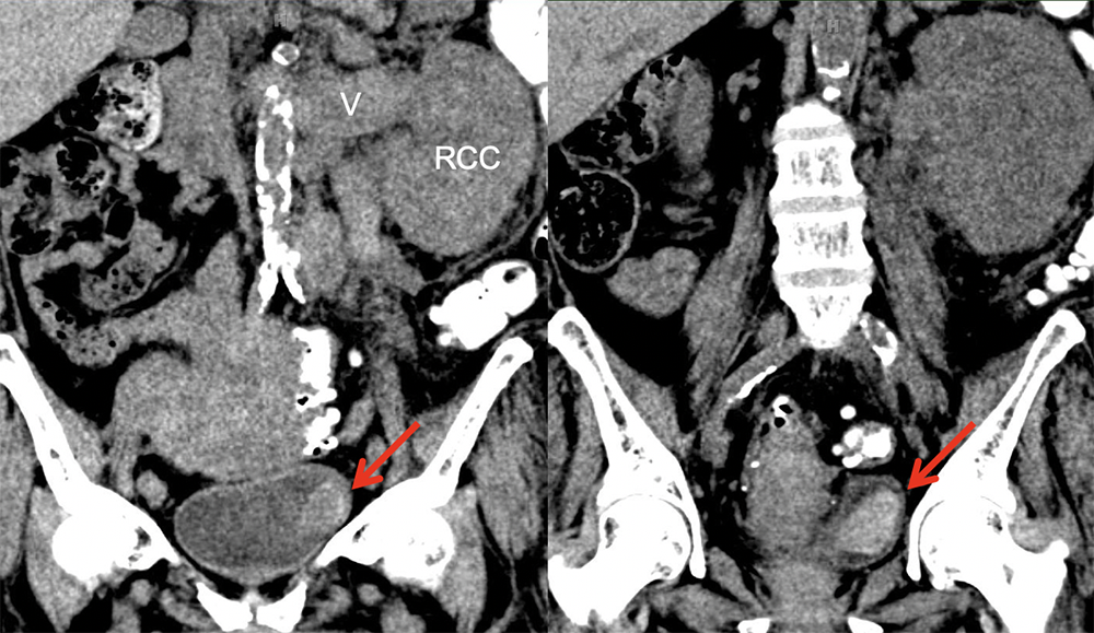 Bladder Hematoma 