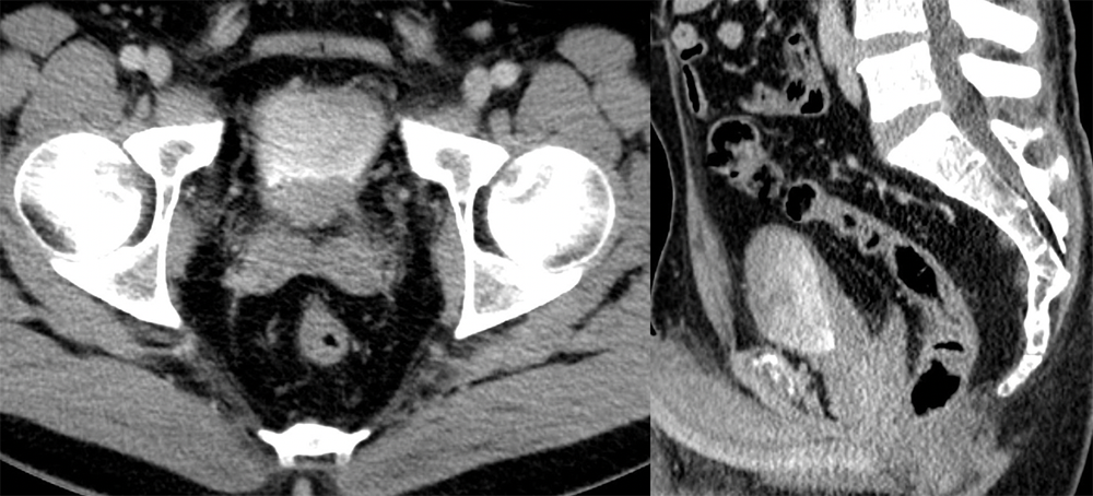 Cystitis Cystica