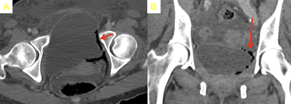 Emphysematous Cystitis