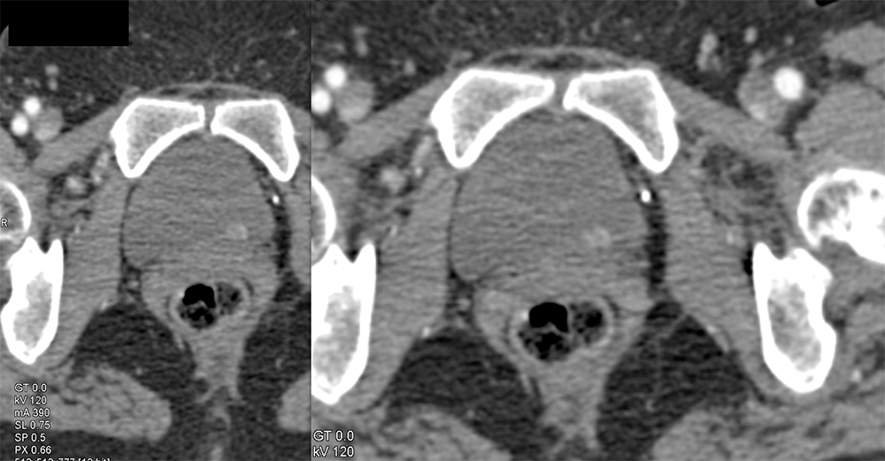 Bladder Cancer-Subtle Enhancement