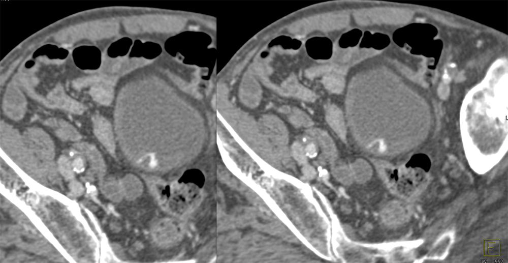 Bladder Cancer-Subtle Enhancement