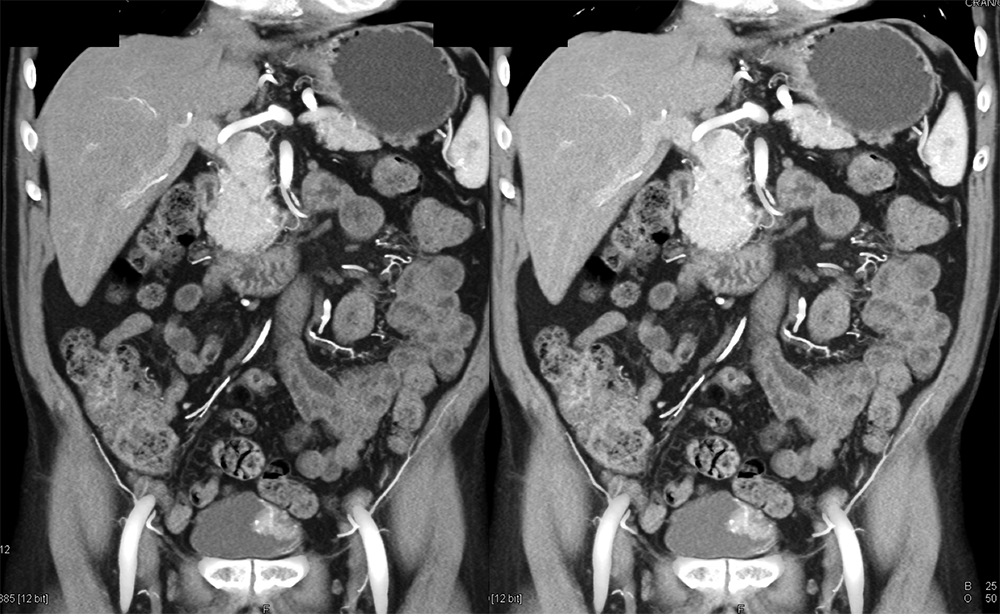 Bladder Cancer in Patient with hematuria