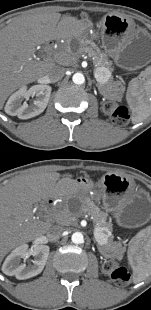 Metastatic RCC to Pancreas only Seen on Arterial Phase