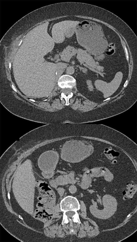 Right Nephrectomy for Clear Cell RCC: Routine Follow-up 