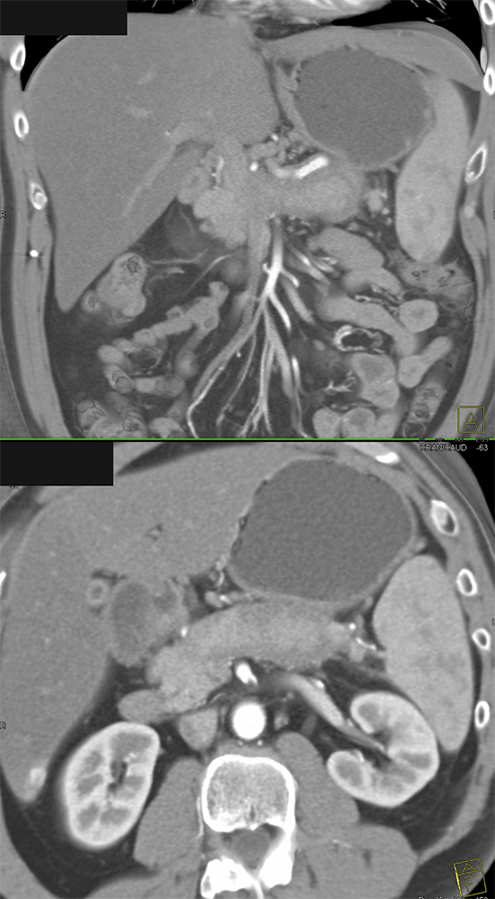 Autoimmune Pancreatitis