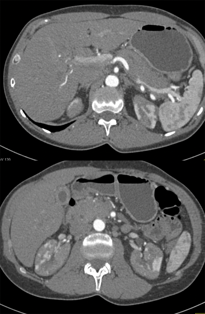 Autoimmune Pancreatitis and Renal Involvement