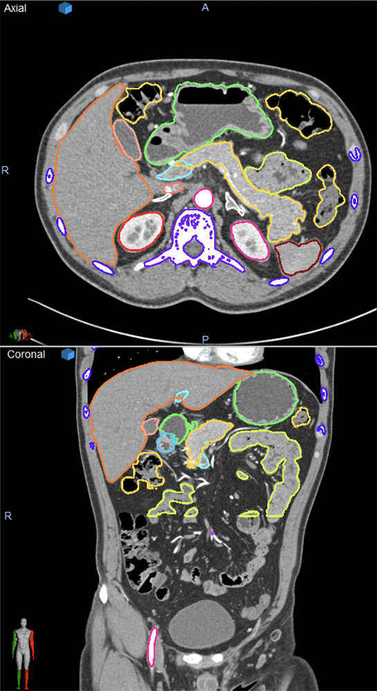 Training the Computer with Organ Segmentation for the Pancreas