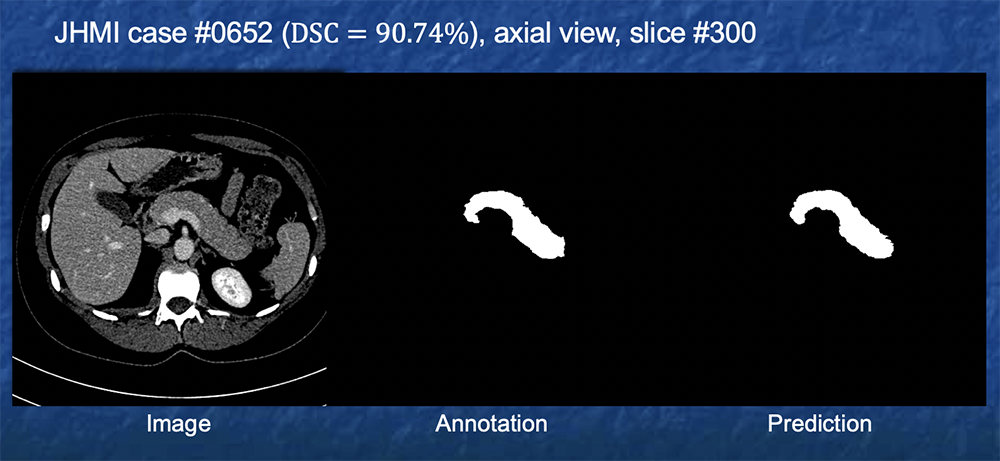 Example of Pancreas Segmentation