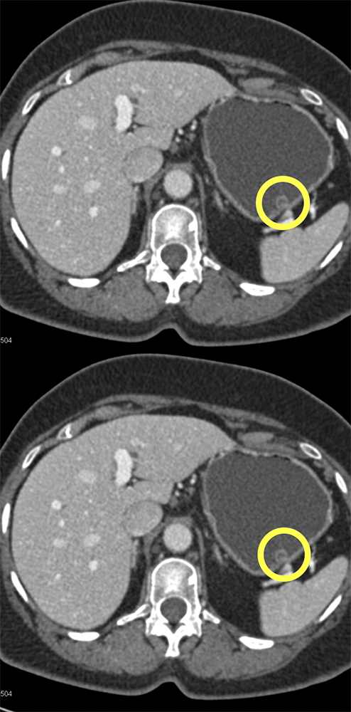 Gastric Polyp