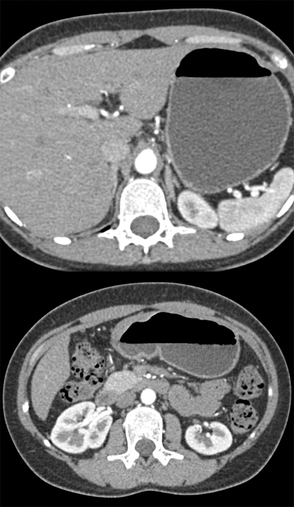 Gastric Adenocarcinoma