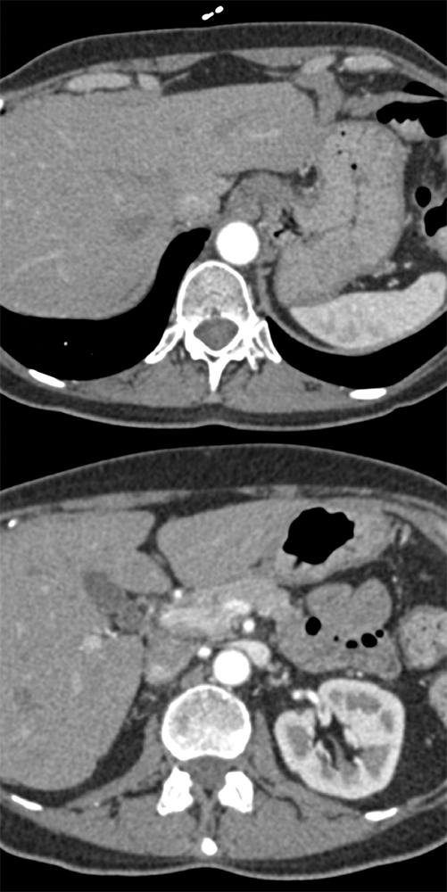 Stomach Not Distended vs Gastric Malignancy?