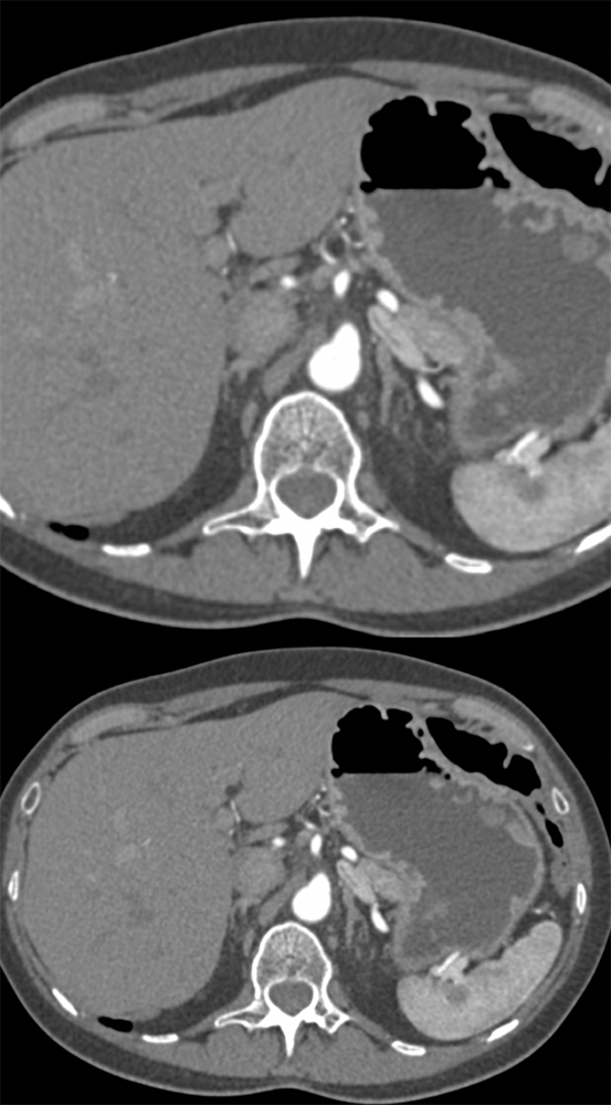 Gastric Polyps (benign)