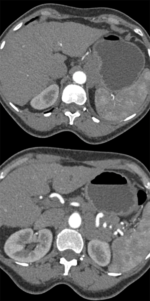 Dx: Suspected Pancreatic Mass