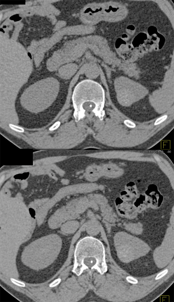 High Density Renal Cyst