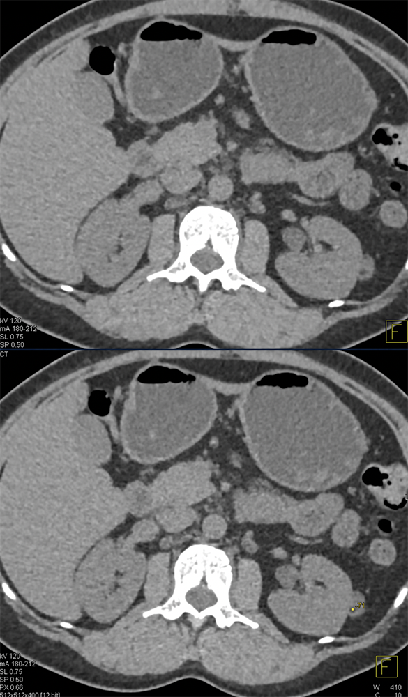 Dilemma: The Small Incidental Renal Lesion