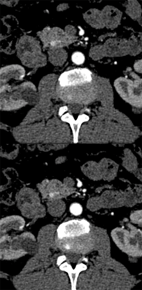 5 mm Neuroendocrine Tumor HOP