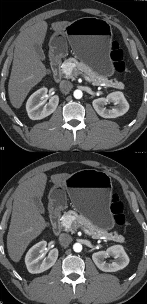 Neuroendocrine Tumor HOP Seen Only On Arterial Phase