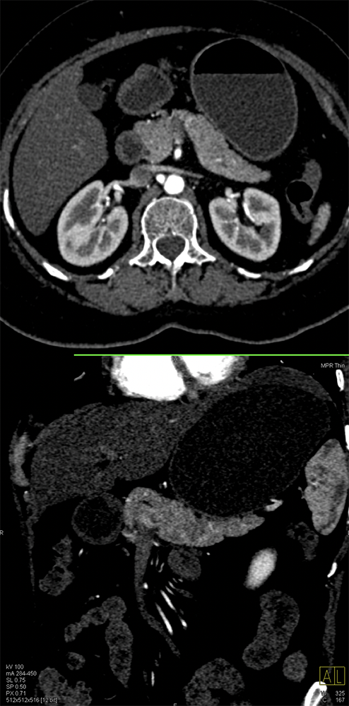 PNET Only Seen on Venous Phase with Cinematic Rendering