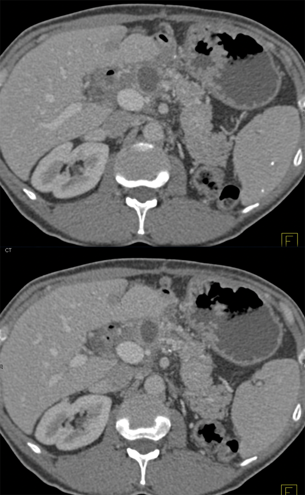 Hx- Renal Cell CarcinomaDo you see a pancreatic mass?