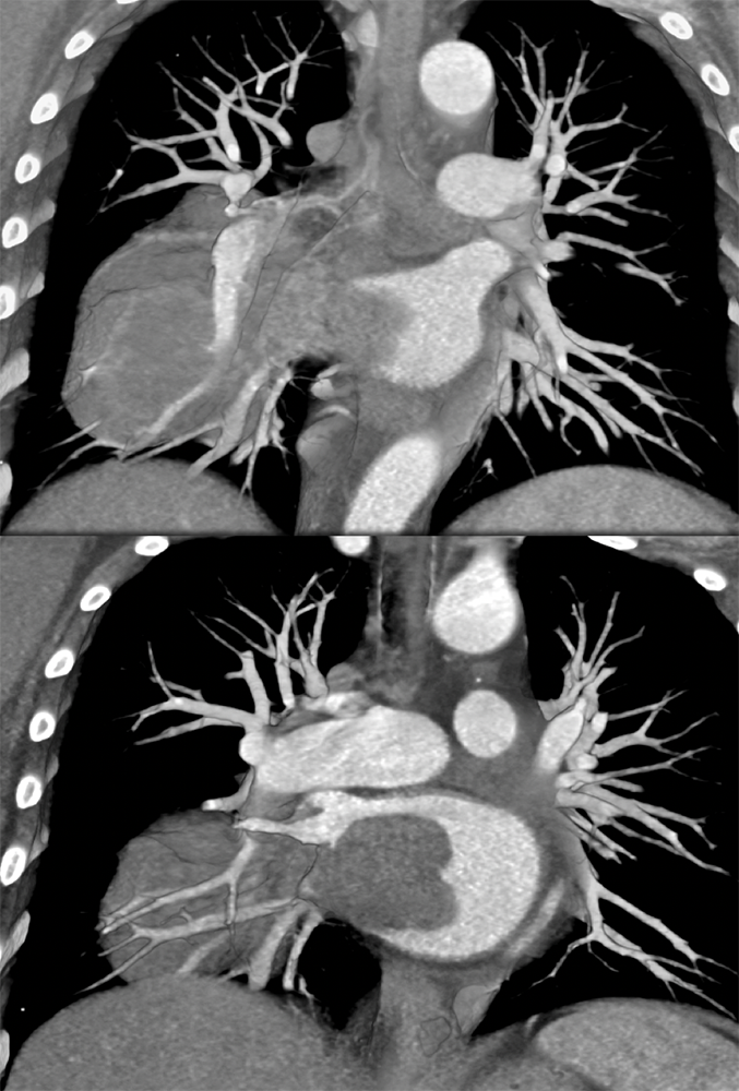 Metastatic Melanoma Grows into Left Atrium