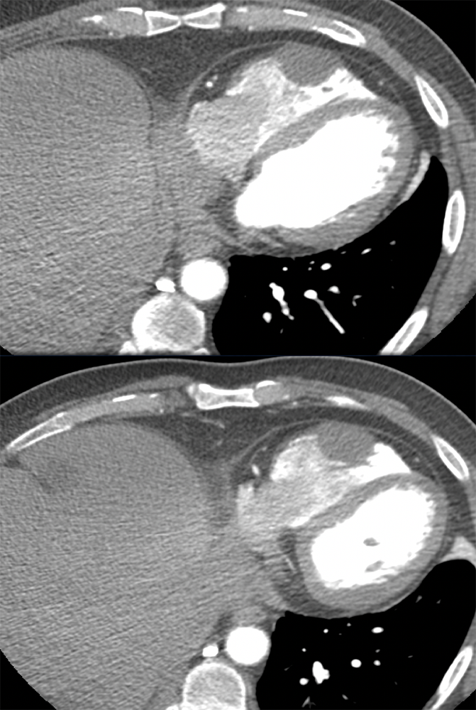 Adenoid Cystic Tumor Metastatic to the Right Ventricle