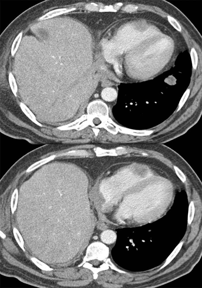 Adenoid Cystic Tumor Metastatic to the Right Ventricle